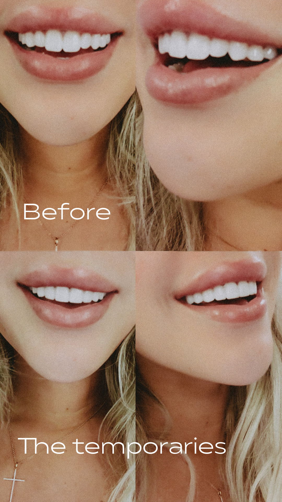 Hayley Larue Veneers | Smile | Veneers Before and After | Beverly Hills Dentist